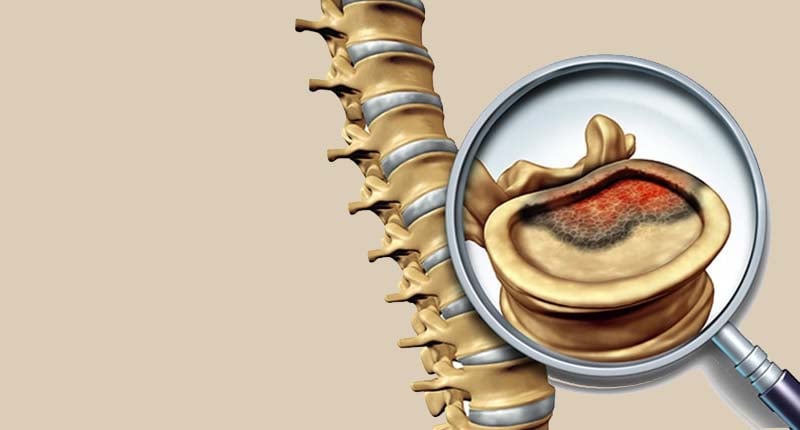Back Pain or Something More? When Does a Spine Tumor Require Surgery?