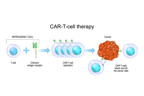 Bone Marrow Transplant vs CAR-T Cell Therapy: Which Is Better for Blood Cancer?