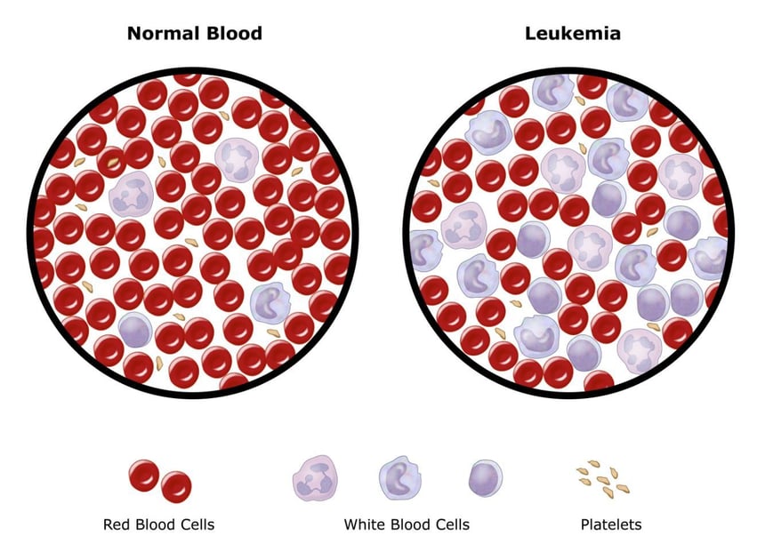 Can You Survive Leukemia Without a Bone Marrow Transplant?