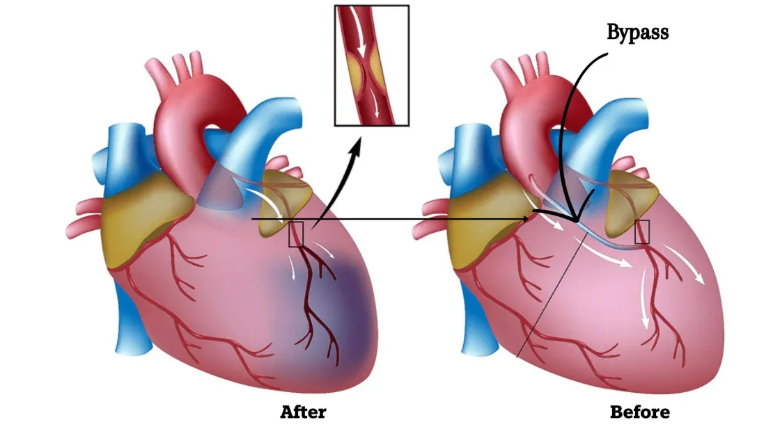 Heart Bypass Surgery in India: Types, Latest Techniques, and Recovery