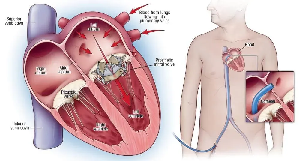 Heart Valve Replacement Surgery in India: Types, Technologies, and Recovery
