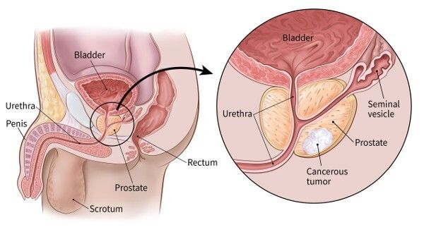 HIFU Treatment for Prostate Cancer in India: Procedure, Cost, and Recovery
