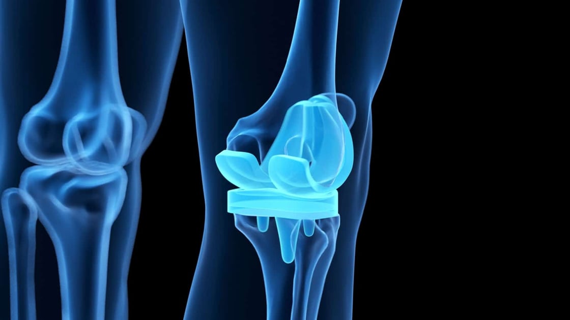 Knee Replacement Surgery in India : A Reliable Solution for Joint Pain