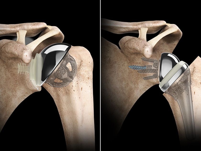 Reemplazo de hombro inverso en India: costo, procedimiento, recuperación