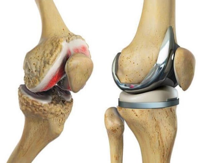 Reemplazo robótico de rodilla en India: beneficios, resultados y costo