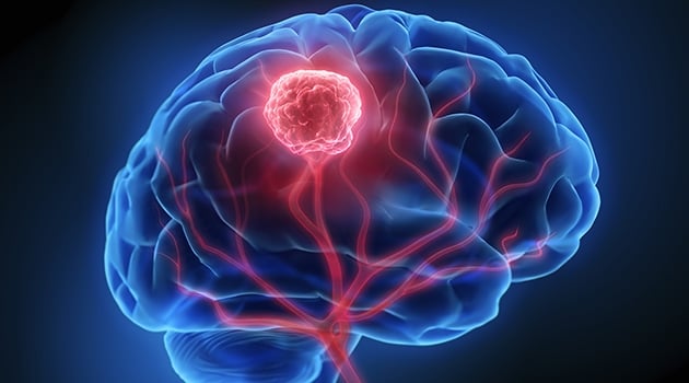Understanding Brain Tumor and its Treatment in India