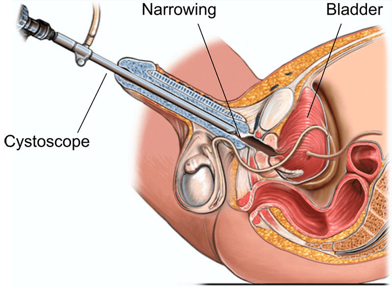 Uretroplastia en India: procedimiento, tasas de éxito, costo y recuperación