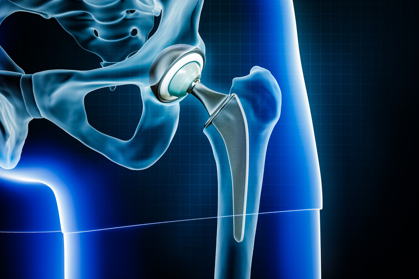 Your Complete Guide to Hip Replacement Surgery in India with Qonaq