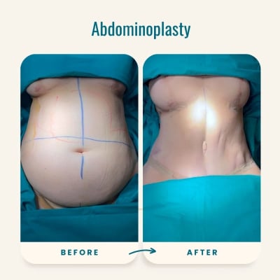 Abdominoplasty (Tummy Tuck)