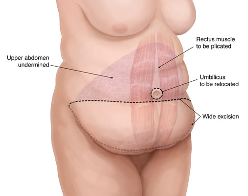 Abdominoplasty (Tummy Tuck) - Image 2