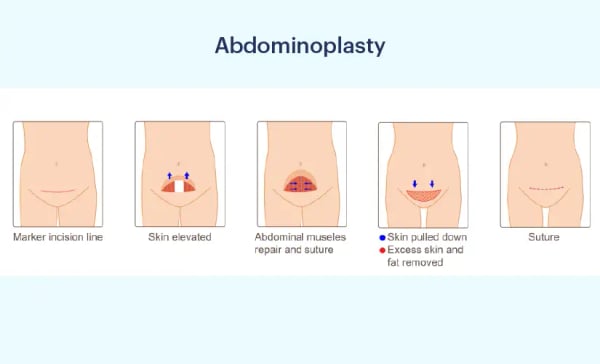 Abdominoplasty (Tummy Tuck) - Image 3
