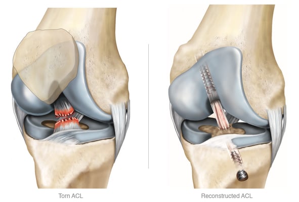 Anterior Cruciate Ligament - ACL Surgery - Image 2