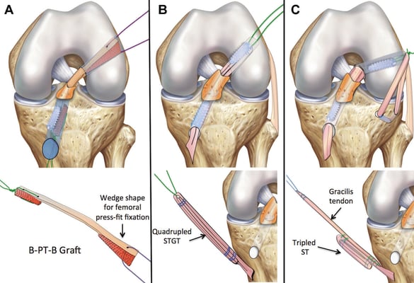 Anterior Cruciate Ligament - ACL Surgery - Image 3