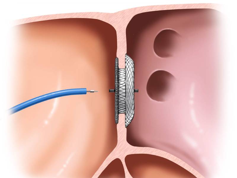 Atrial Septal Defect - ASD Closure