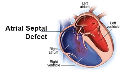 Atrial Septal Defect - ASD Closure - Image 2