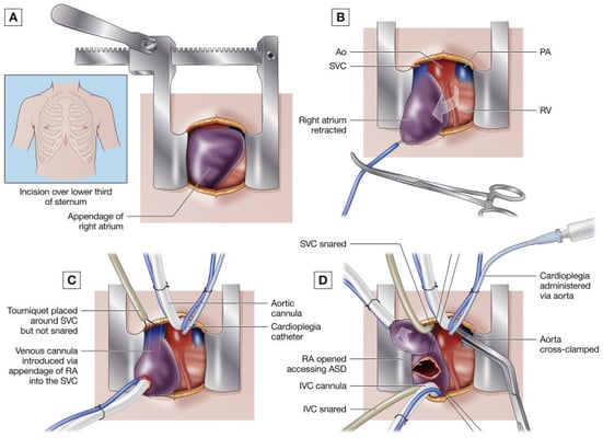 Atrial Septal Defect - ASD Closure - Image 3
