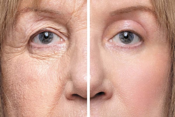 Blepharoplasty (Eyelids)
