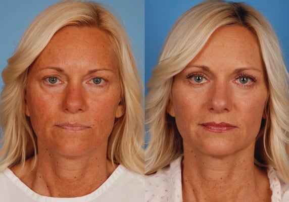 Blepharoplasty (Eyelids) - Image 2
