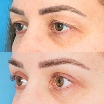 Blepharoplasty (Eyelids) - Image 3
