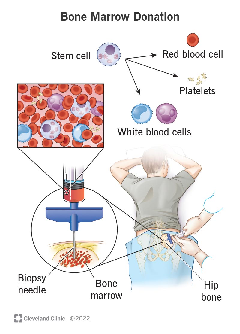 Bone Marrow Transplant - BMT - Image 2