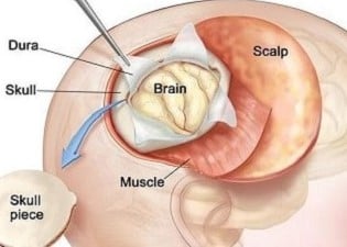 علاج سرطان الدماغ - Image 2