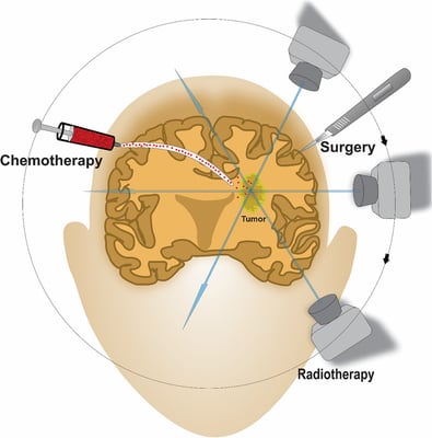 علاج سرطان الدماغ - Image 3