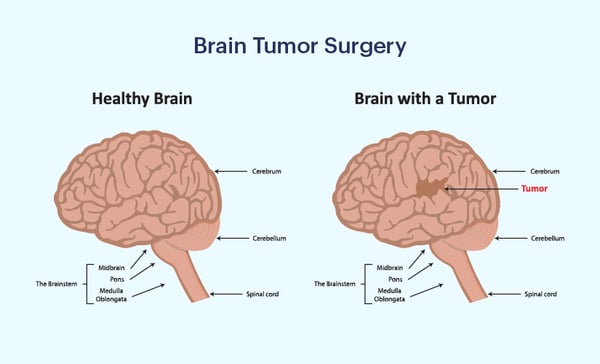 Brain Tumour Surgery