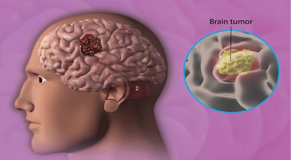 Brain Tumour Surgery - Image 2