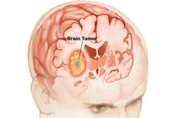 Brain Tumour Surgery - Image 3