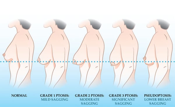Breast Augmentation - Image 2