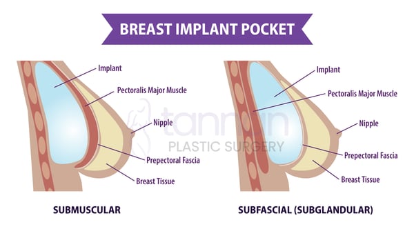 Breast Augmentation - Image 3