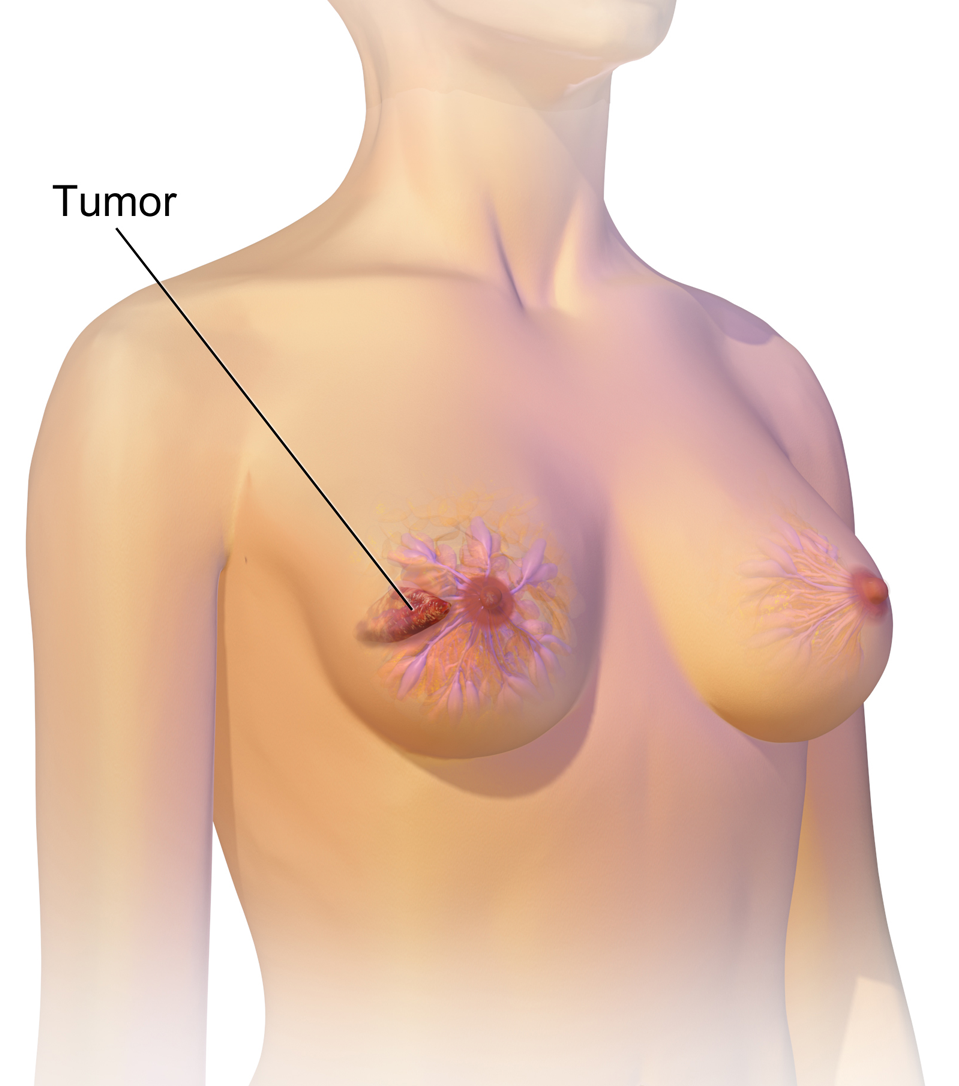 Breast Cancer Treatment