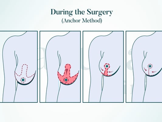 Breast Lift - Image 2