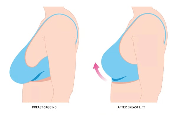 Breast Lift - Image 3