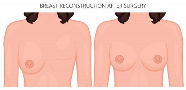 Breast Reconstruction Surgery