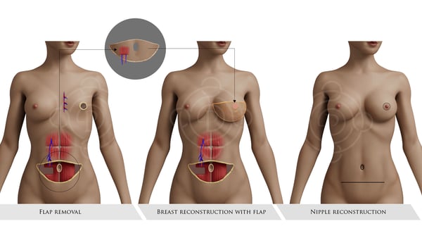 Breast Reconstruction Surgery - Image 2