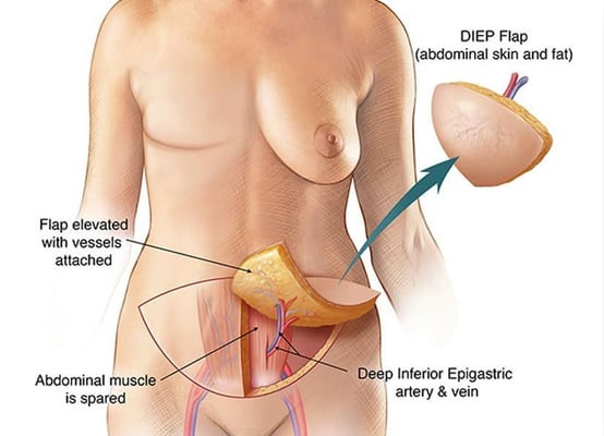 Breast Reconstruction Surgery - Image 3