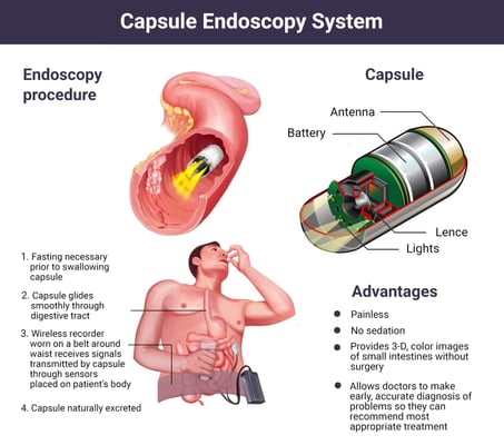Capsule Endoscopy