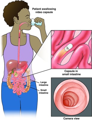 Capsule Endoscopy - Image 2