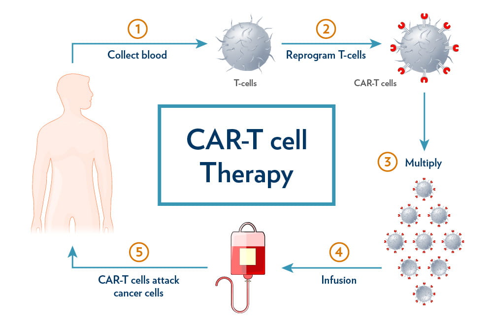 CAR T-Cell Therapy