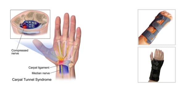 Carpal Tunnel Surgery - Image 2