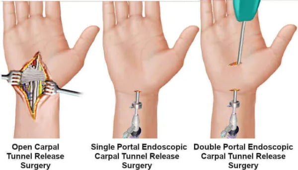 Carpal Tunnel Surgery - Image 3