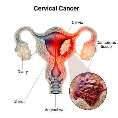 Cervical Cancer Treatment