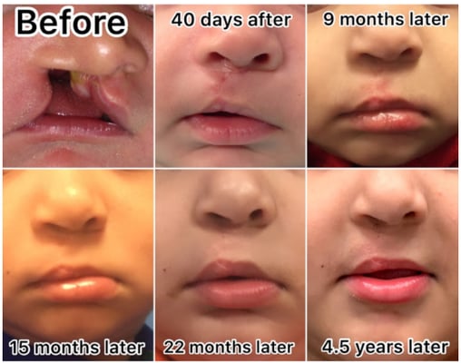 Cleft Lip Surgery