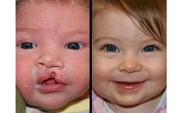 Cleft Lip Surgery - Image 2