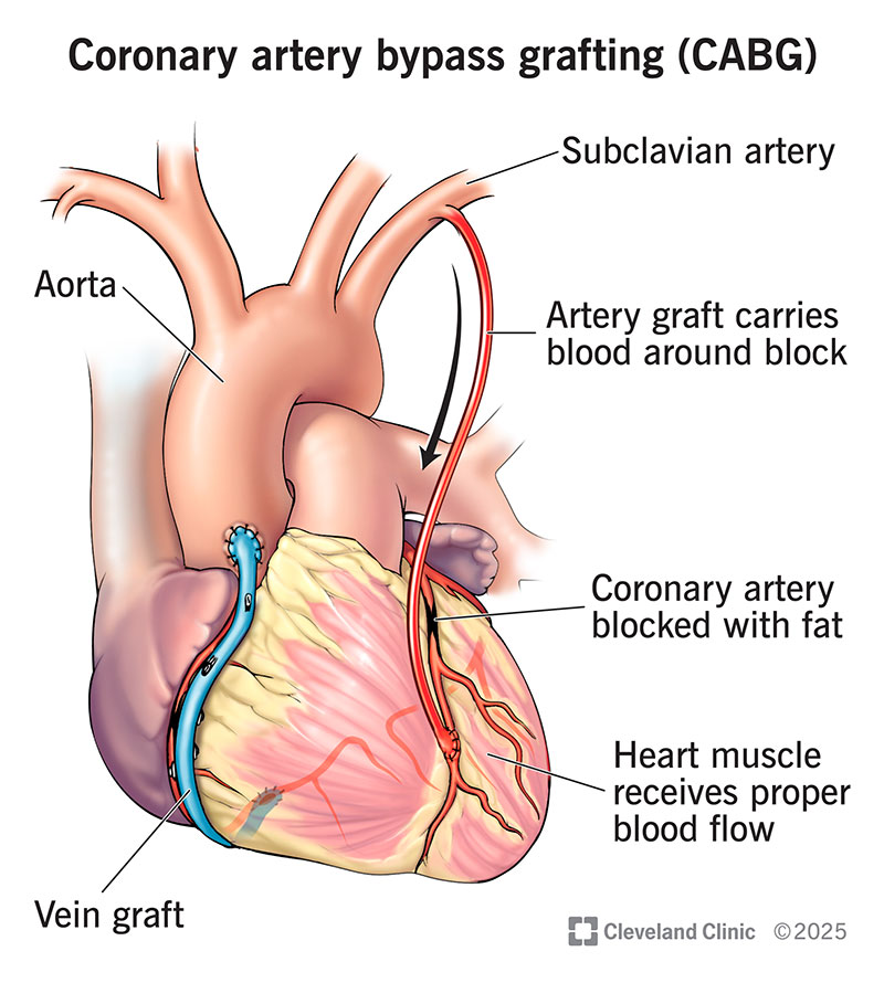 Coronary Artery Bypass Graft Surgery - CABG