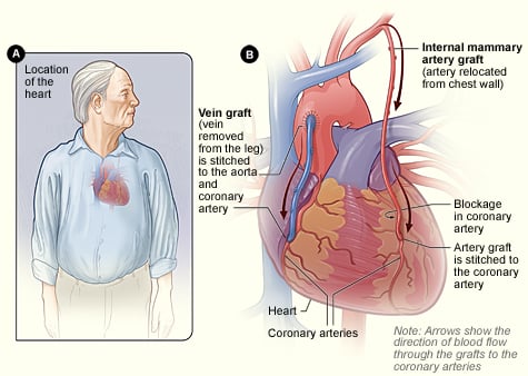 Coronary Artery Bypass Graft Surgery - CABG - Image 2