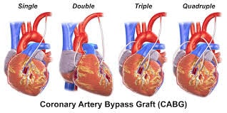 Coronary Artery Bypass Graft Surgery - CABG - Image 3