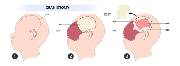 Craniotomy