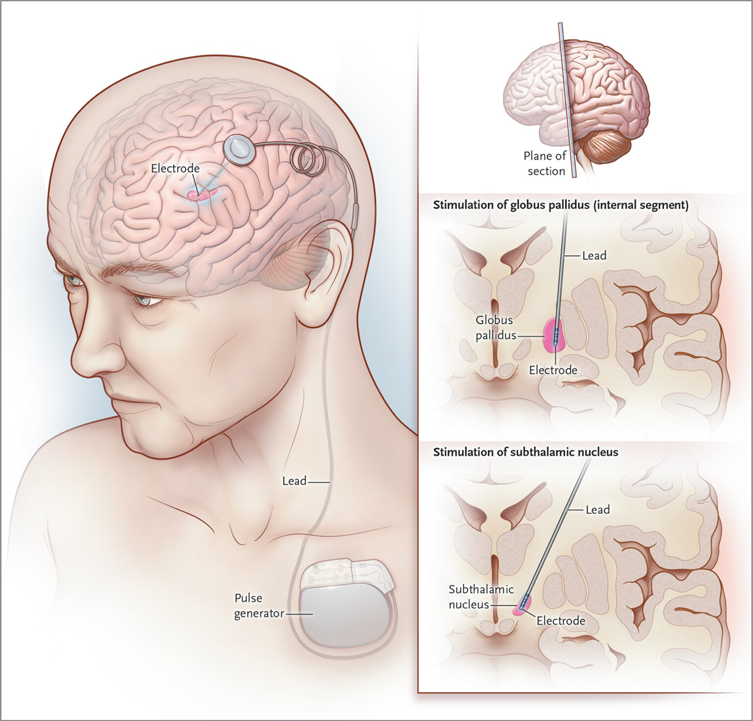 Deep Brain Stimulation (DBS)